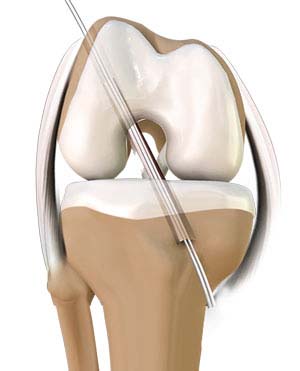 ACL Reconstruction Nashville, ACL Injury