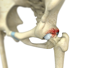 Hip Labral Tear