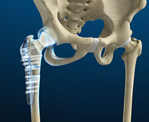 Hip Labral Tear