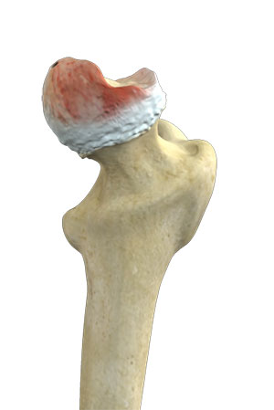 Hip Labral Tear