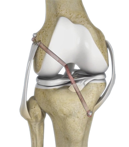 Multiligament Knee Reconstruction