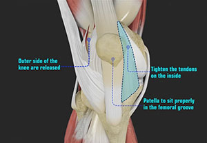 Meniscus Replacement