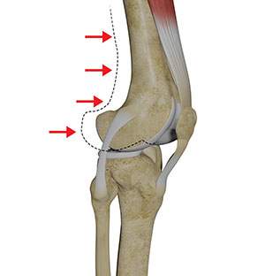 Posterolateral Instability