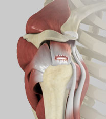 Rotator Cuff Tendinopathy