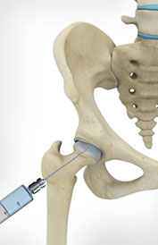 Research on Efficacy of Intra-Articular Hyaluronic Acid and Cortisone Compared to Cortisone alone for Symptomatic Hip Osteoarthritis. Accepted to Journal of Arthritis